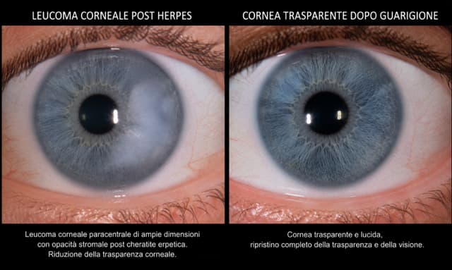 Collirio al Losartan per cicatrici corneali