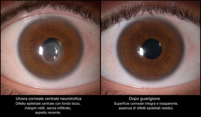 Collirio all’insulina per la cornea